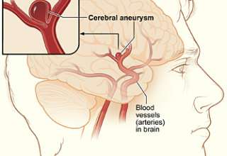 brain aneurysms, Isabel Granada, risk factors, prevention, treatment